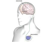 Graphic demonstrating deep brain stimulation